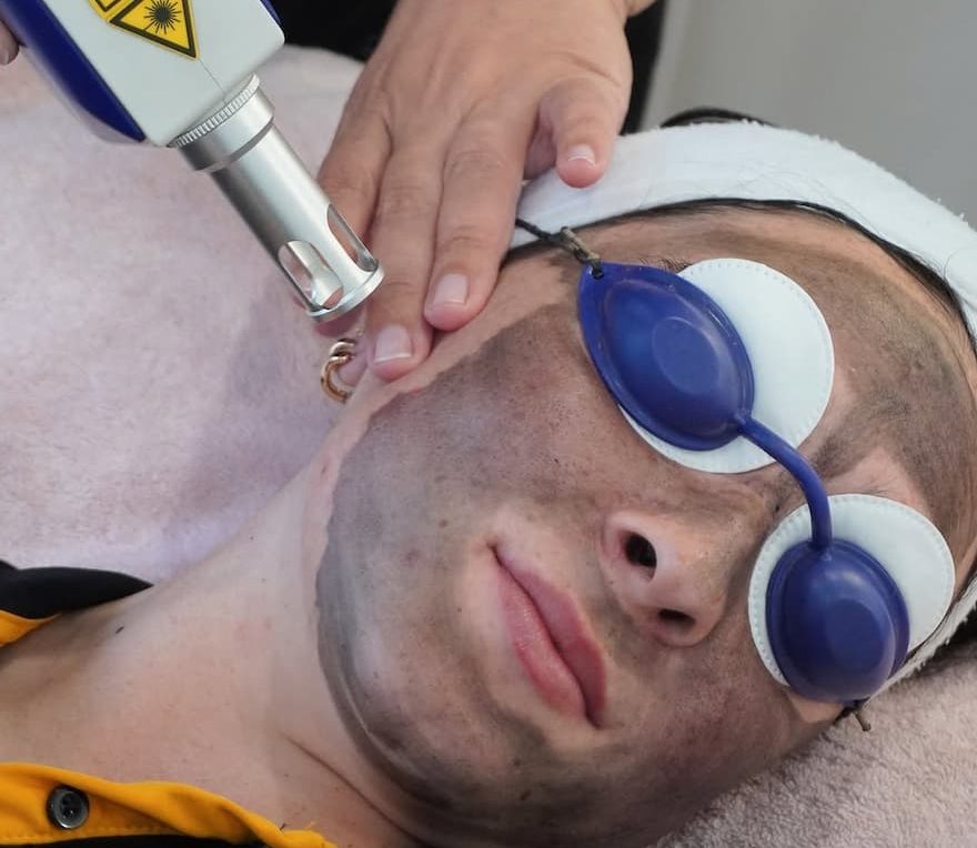 carbon doll facial service in newcastle