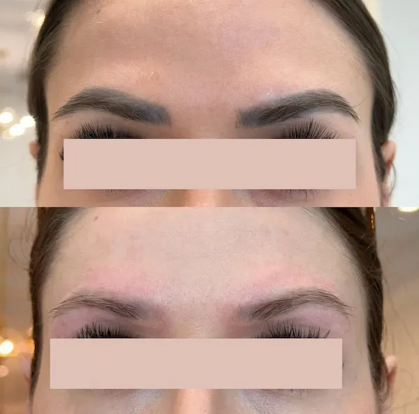 newcastle tatto removal before after