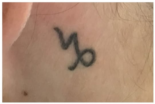 advanced tatto removal newcastle before