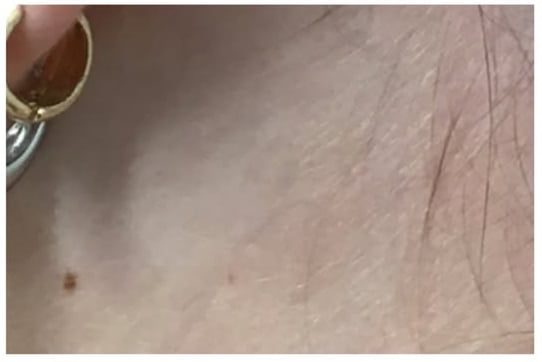 advanced tattoo removal newcastle after