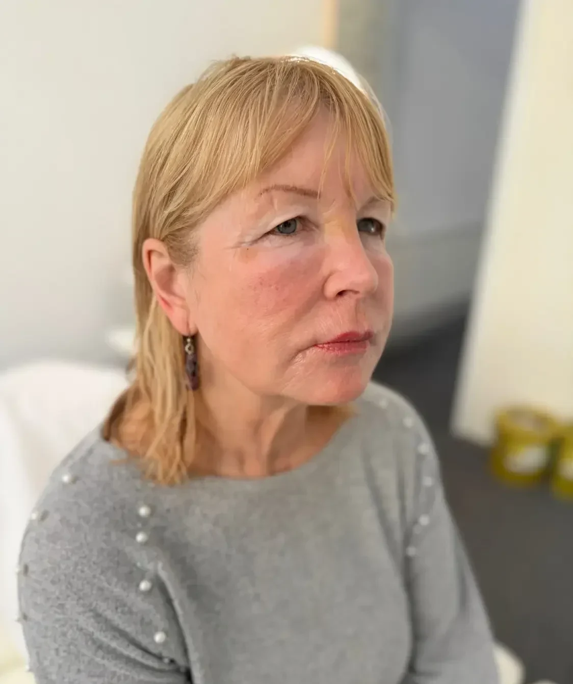 Before Aesthetic Clinic Newcastle by dr Shaymaa