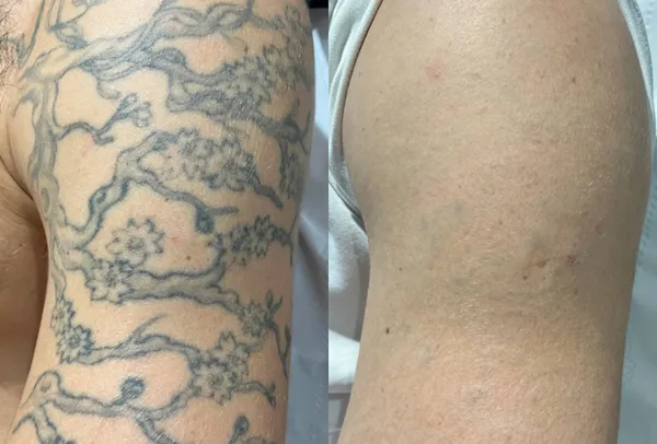 tattoo removal near me
